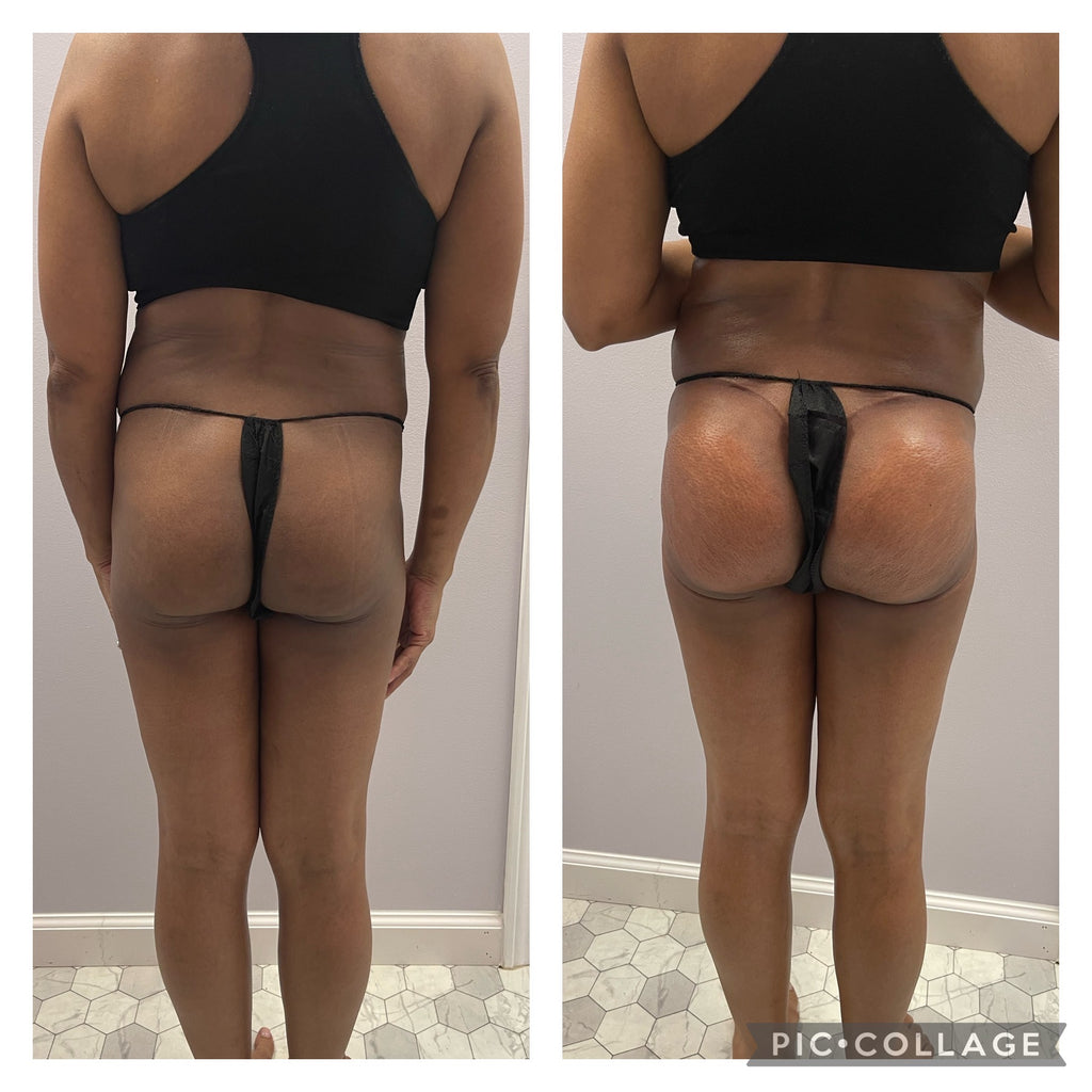 Natural BBL Package