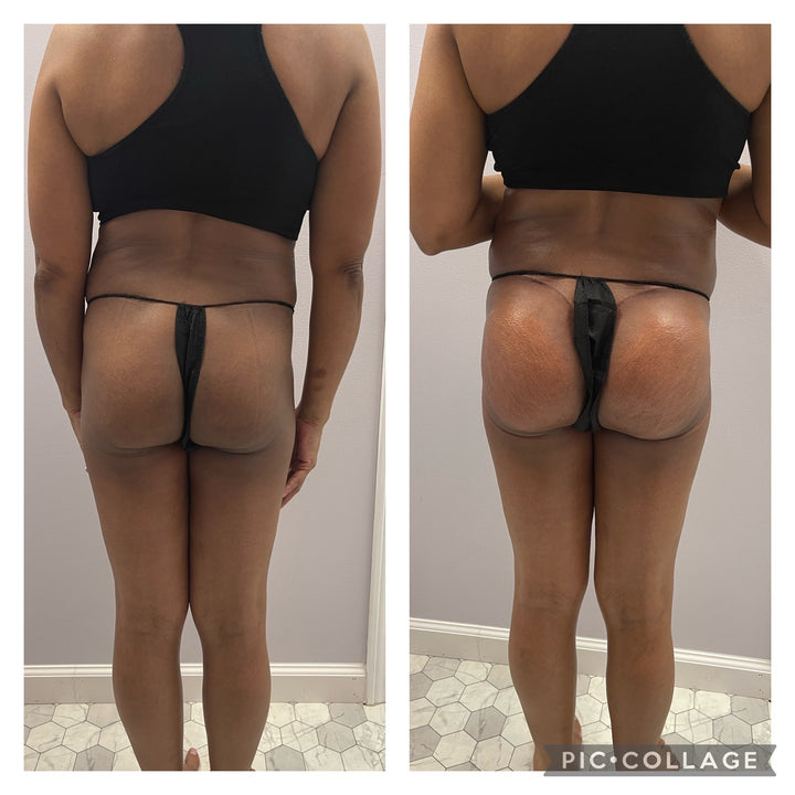 Natural BBL Package